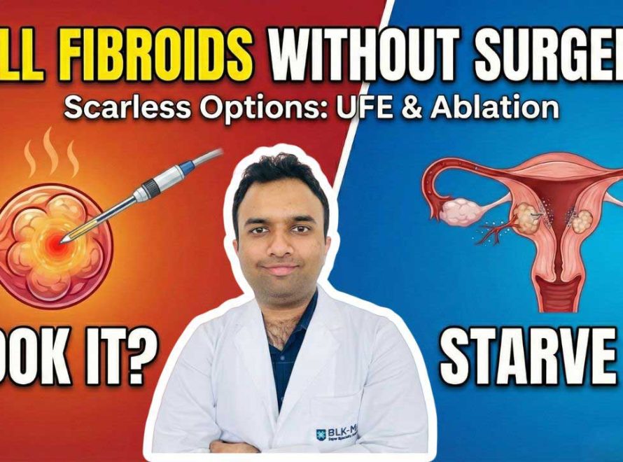 Dr. Akash Bansal comparing Uterine Fibroids treatment options: Microwave Ablation (Cooking) vs Uterine Fibroid Embolization (Starving).