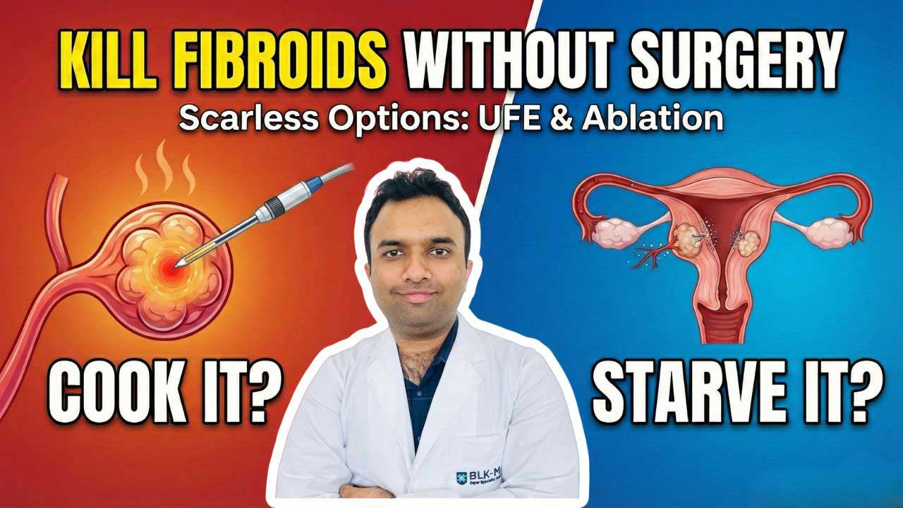 Dr. Akash Bansal comparing Uterine Fibroids treatment options: Microwave Ablation (Cooking) vs Uterine Fibroid Embolization (Starving).