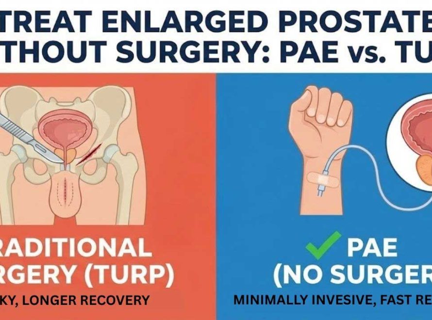 Prostate Artery Embolization: Treat Enlarged Prostate Without Surgery
