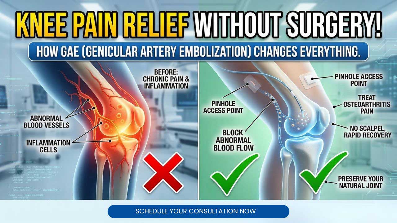 Genicular Artery Embolization: Non-Surgical Knee Pain Relief