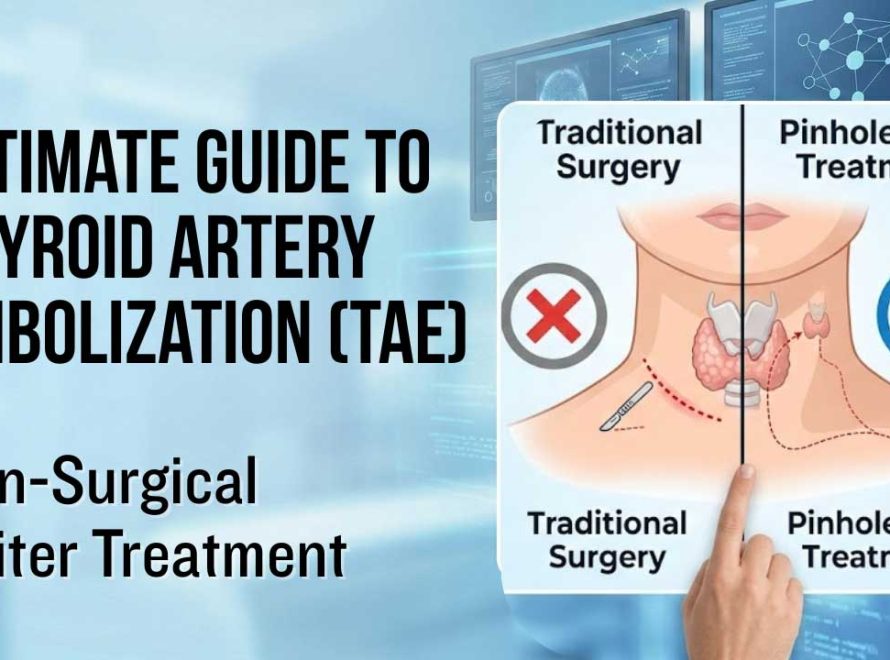 Thyroid Artery Embolization (TAE): Non-Surgical Guide